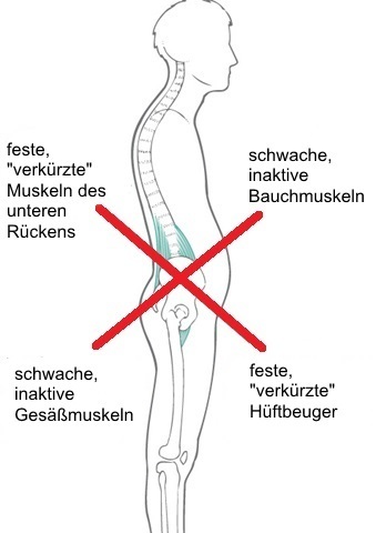 Hohlkreuz? Mache DAS für eine geradere Haltung (Hyperlordose