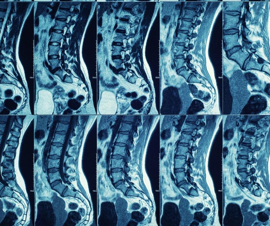 Osteochondrose in der LWS behandeln mit bildgebenden Verfahren