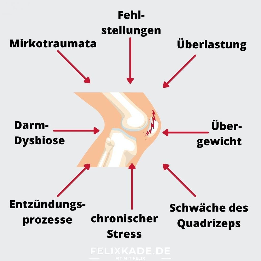 Chondropathie im Knie: Schmerzen hinter der Kniescheibe behandeln
