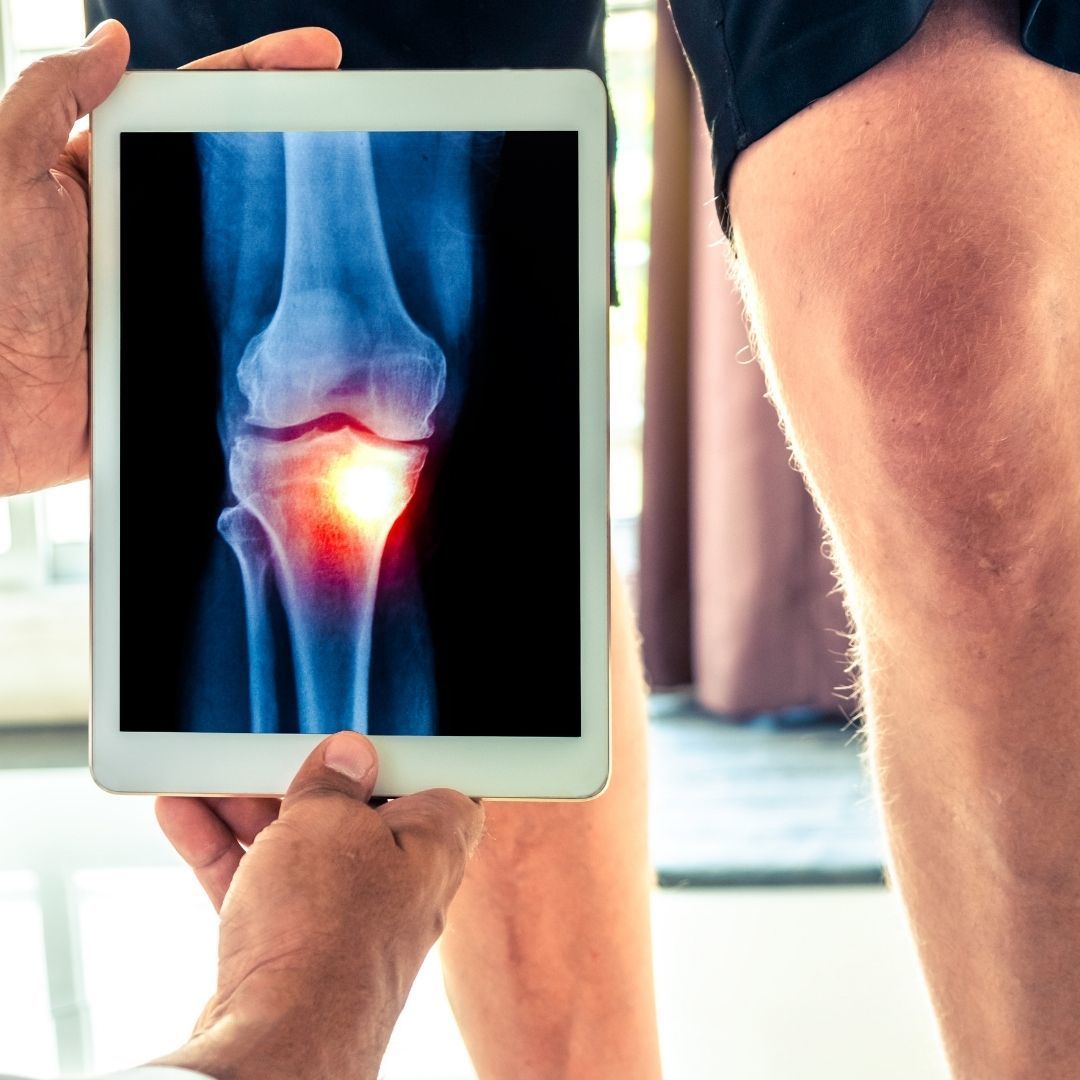 Knirschen im Knie Wie schlimm ist es wirklich? www.felixkade.de