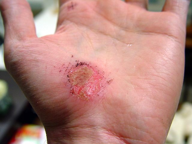640px-Hand_Abrasion_-_2_days_22_hours_12_minutes_after_injury Wunde an der Hand