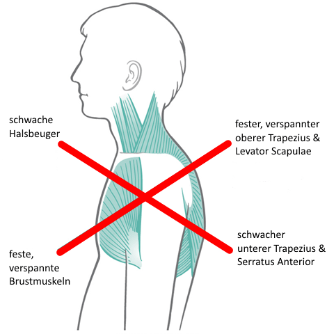 Upper Cross Syndrom